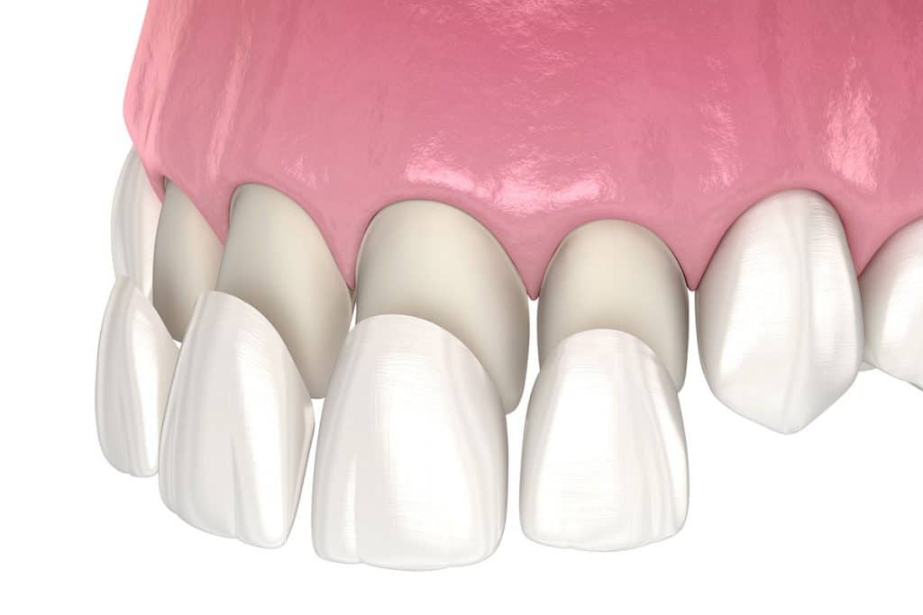 Are Dental Veneers Worth It?