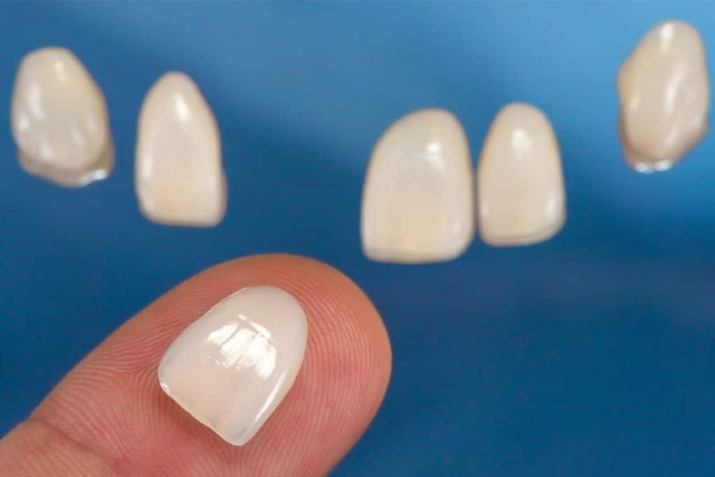 How Long Do Dental Veneers Last?